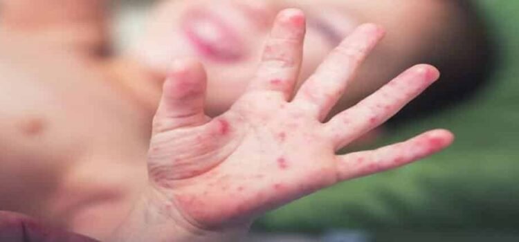 Registra Hidalgo cerca de 400 casos de COXSACKIE en niños durante 2024 Registra Hidalgo cerca de 400 casos de COXSACKIE en niños durante 2024