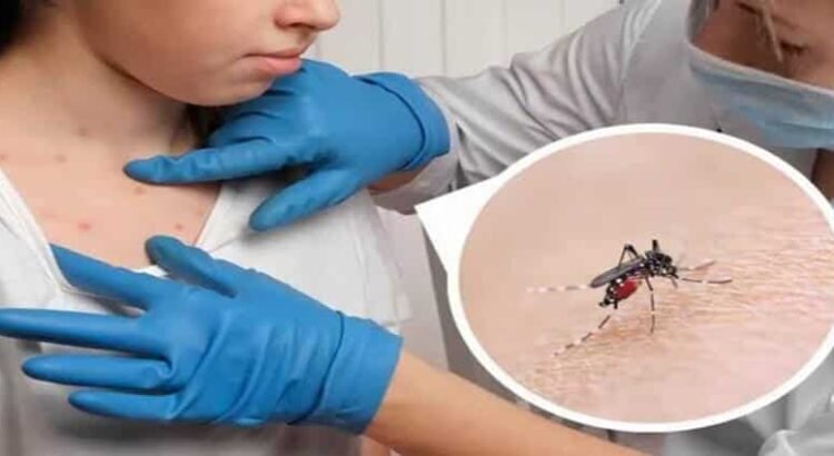Registra Hidalgo ocho casos de dengue con signos de alarma