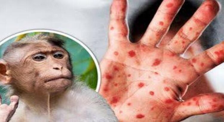 Confirman seis casos de viruela del mono en Hidalgo