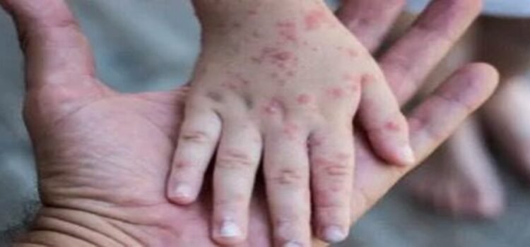 Reporta Salud 32 brotes activos de Coxsackie en Hidalgo Reporta Salud 32 brotes activos de Coxsackie en Hidalgo