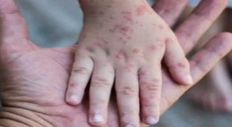 Reporta Salud 32 brotes activos de Coxsackie en Hidalgo Reporta Salud 32 brotes activos de Coxsackie en Hidalgo